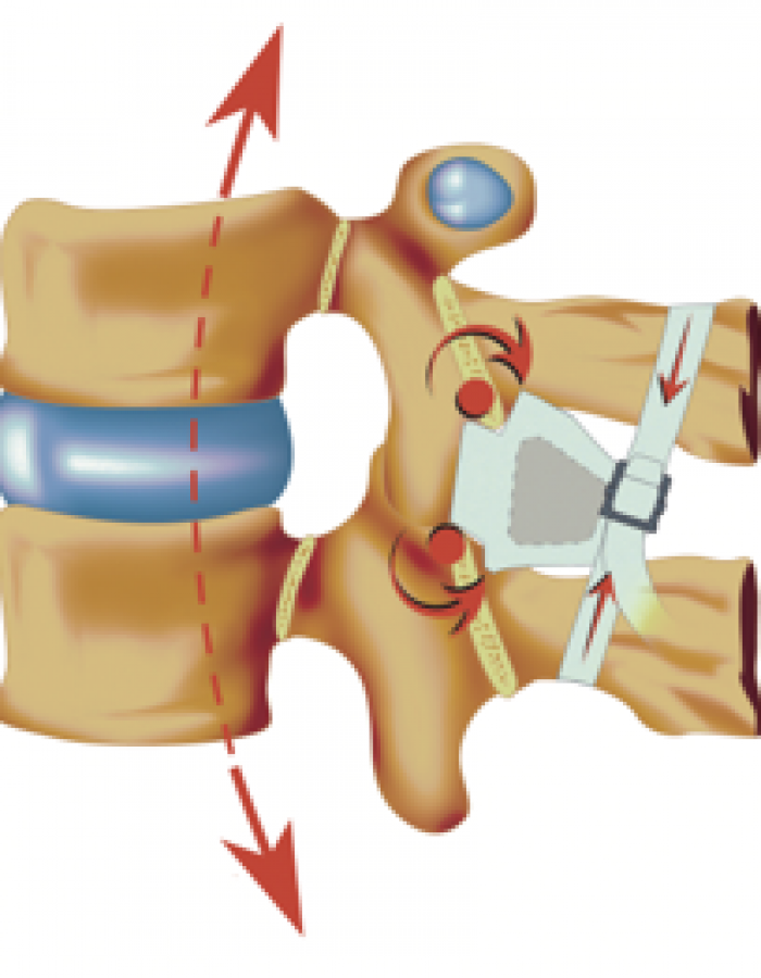 Intraspine_2